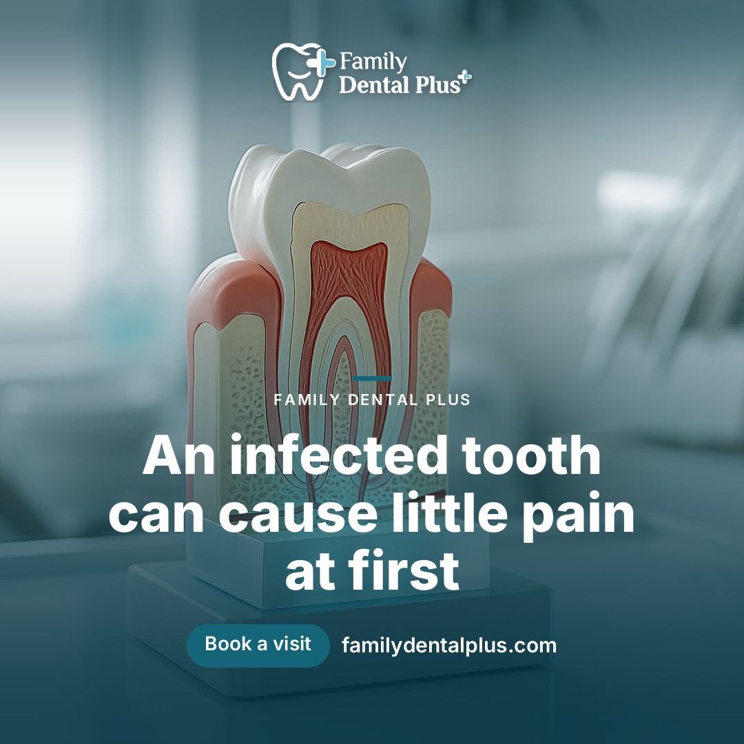 Signs You Might Need a Root Canal